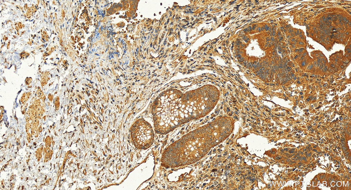 IHC staining of human colon cancer using 30518-1-AP