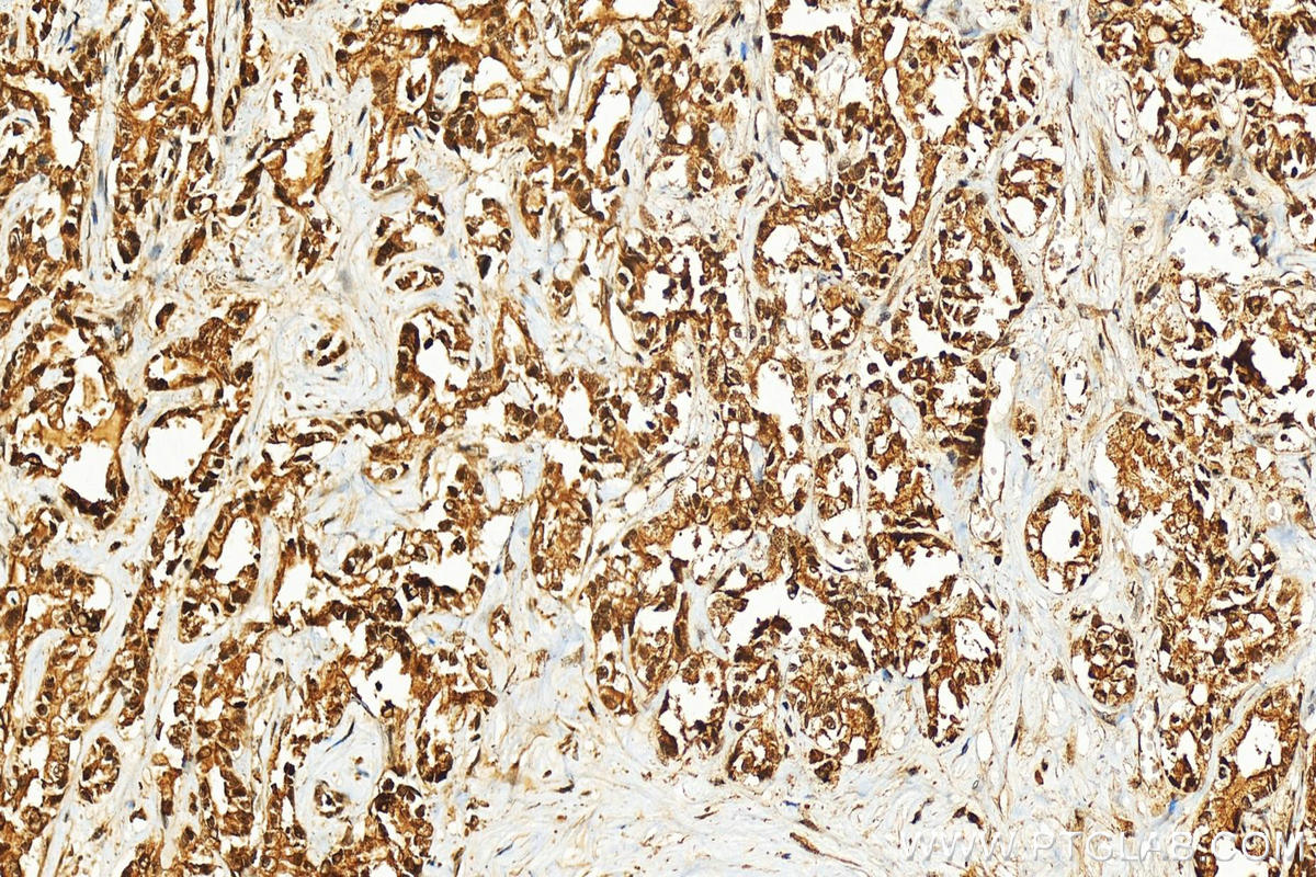 IHC staining of human intrahepatic cholangiocarcinoma using 10200-1-AP