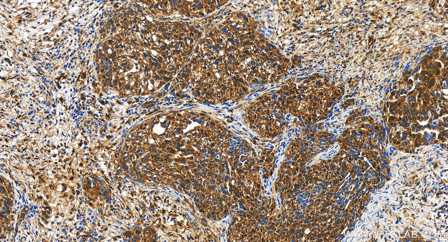 IHC staining of human ovary cancer using 23306-1-AP