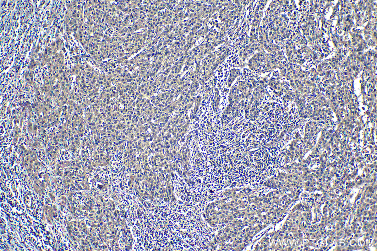 IHC staining of human cervical cancer using 66763-1-Ig (same clone as 66763-1-PBS)