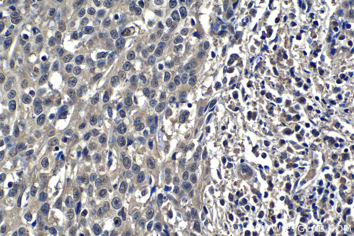 IHC staining of human cervical cancer using 66763-1-Ig