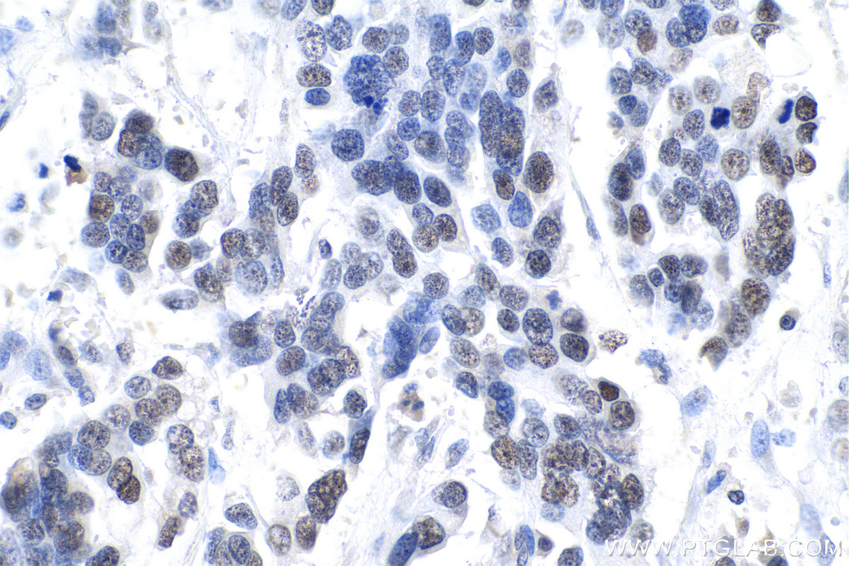 IHC staining of human colon cancer using 21468-1-AP