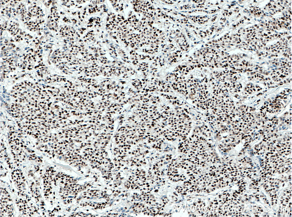 IHC staining of human colon cancer using 66621-1-Ig (same clone as 66621-1-PBS)