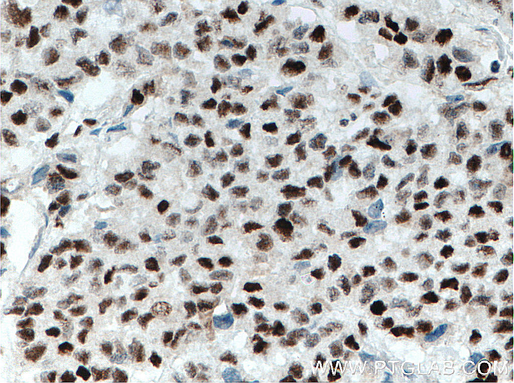IHC staining of human colon cancer using 66621-1-Ig (same clone as 66621-1-PBS)