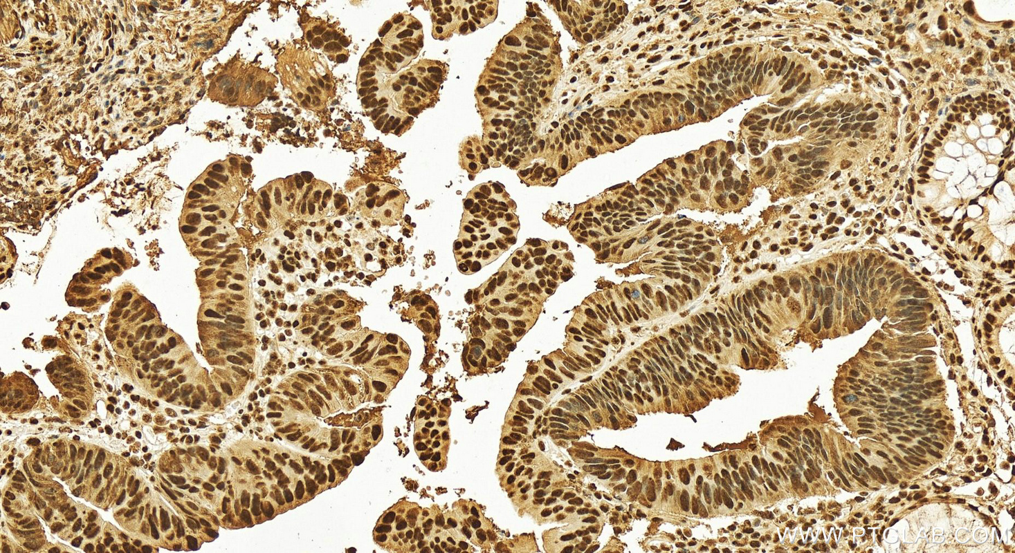 IHC staining of human colon cancer using 16389-1-AP