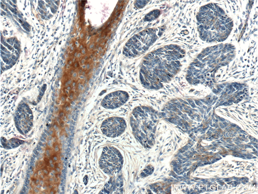 IHC staining of human skin cancer using 26541-1-AP