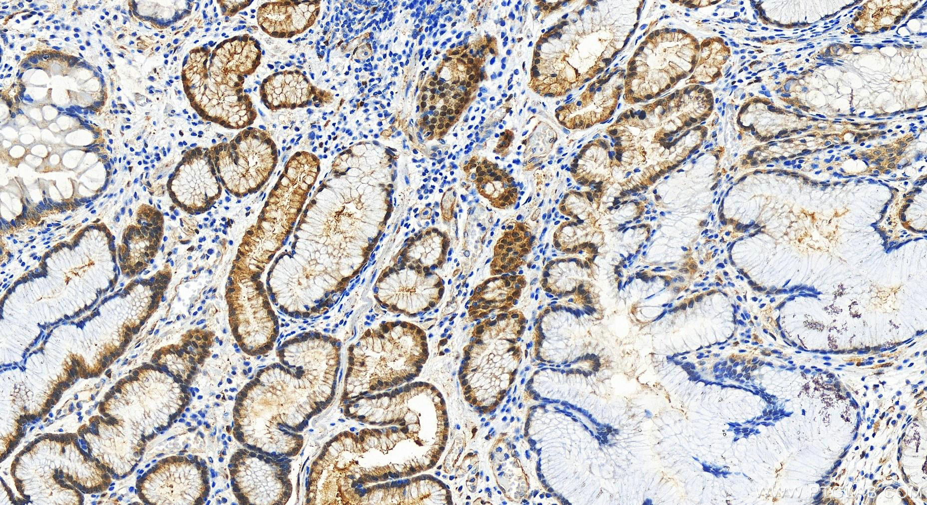 IHC staining of human stomach cancer using 30464-1-AP