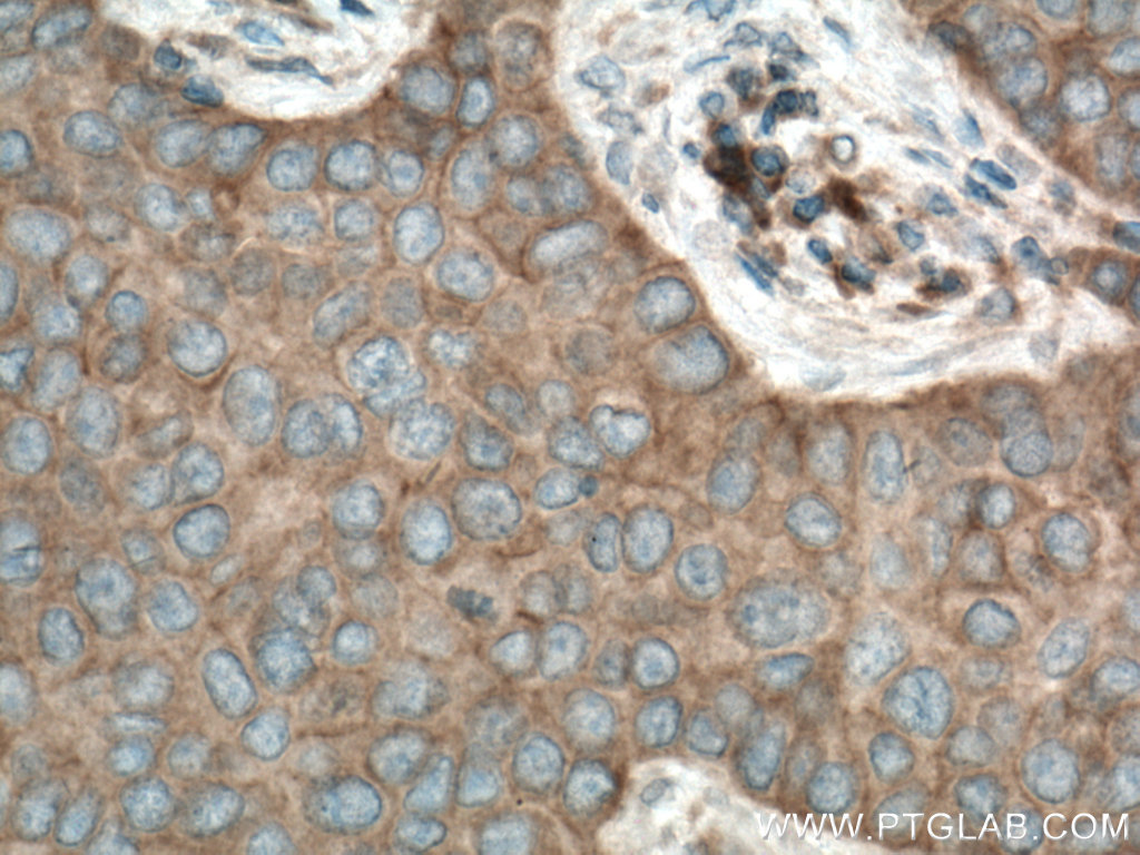 IHC staining of human breast cancer using 13977-1-AP