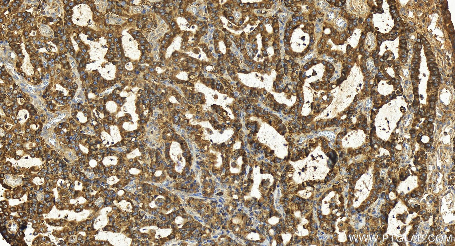 IHC staining of human stomach cancer using 27779-1-AP