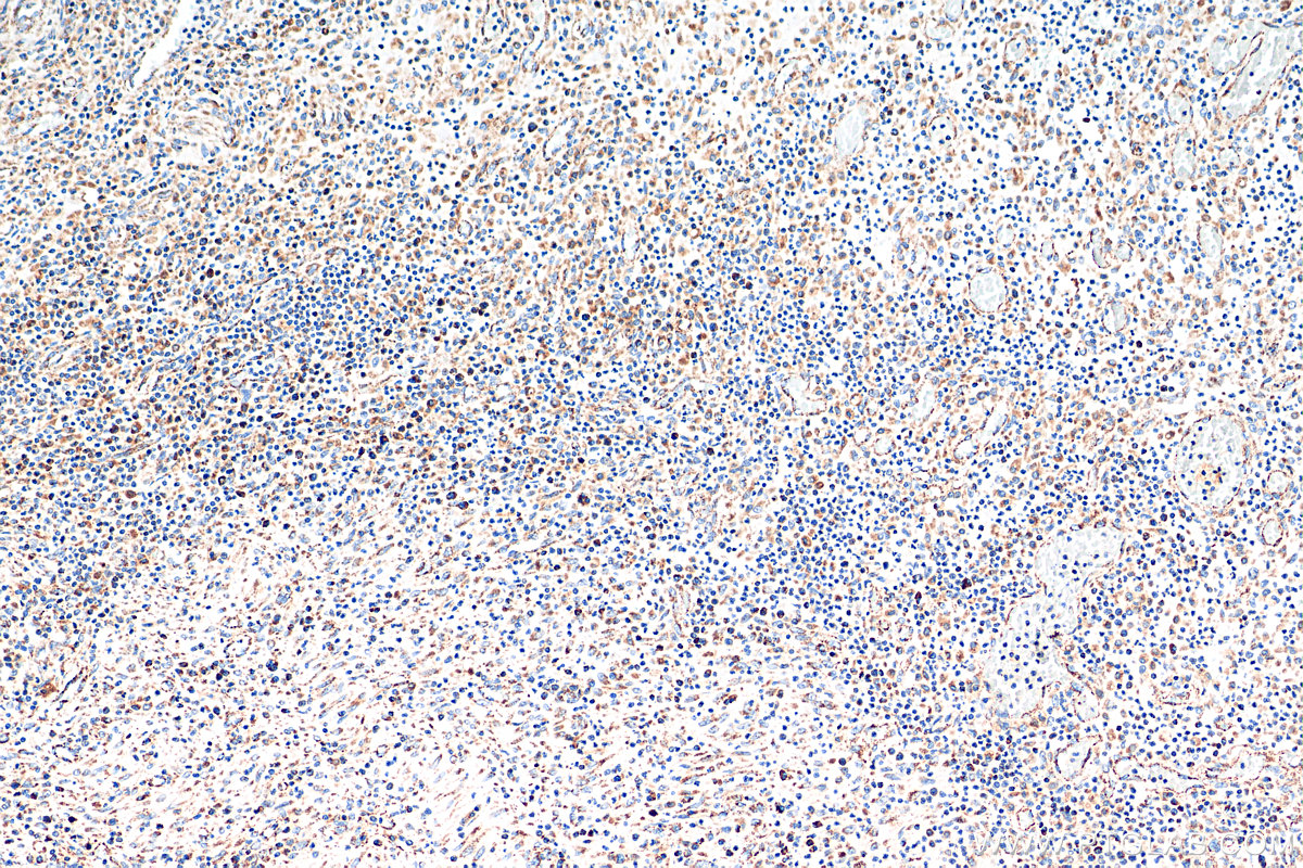 IHC staining of human colon cancer using 10936-1-AP