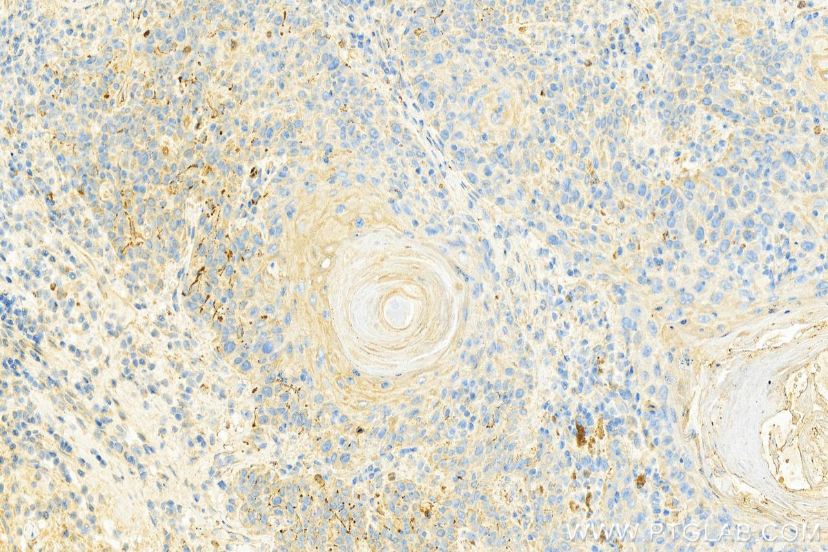 IHC staining of human skin cancer using 15222-1-AP