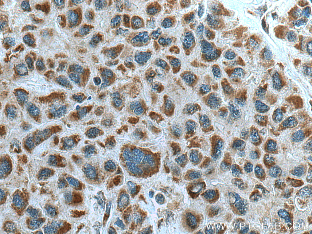 IHC staining of human liver cancer using 14945-1-AP