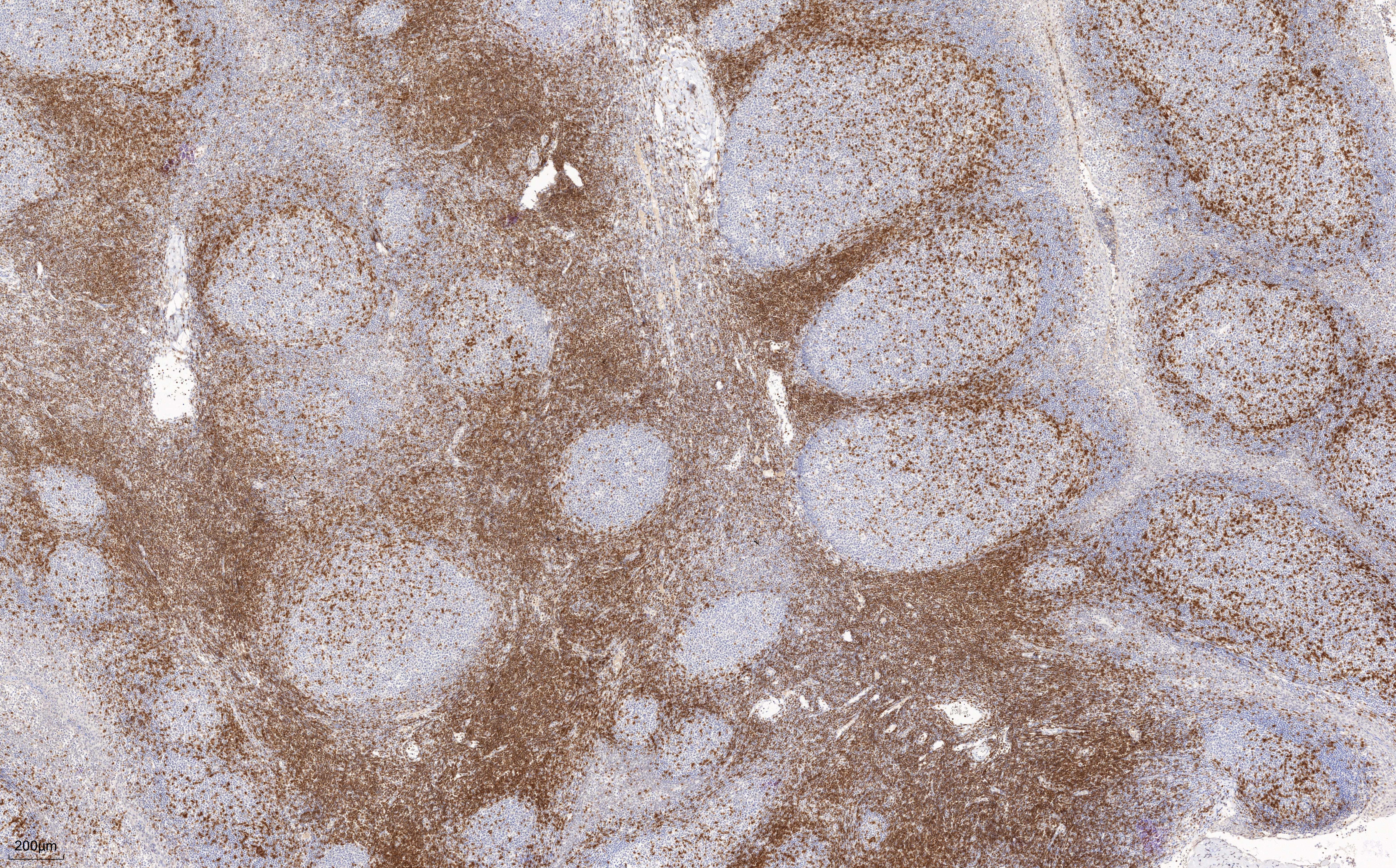 IHC staining of human tonsillitis using 60200-1-Ig (same clone as 60200-1-PBS)