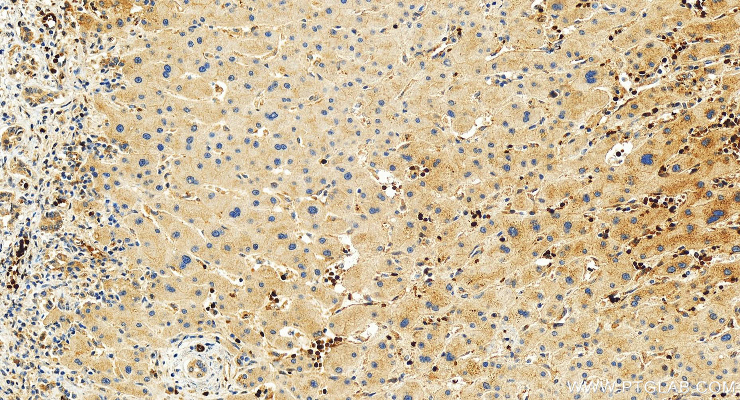 IHC staining of human intrahepatic cholangiocarcinoma using 55270-1-AP