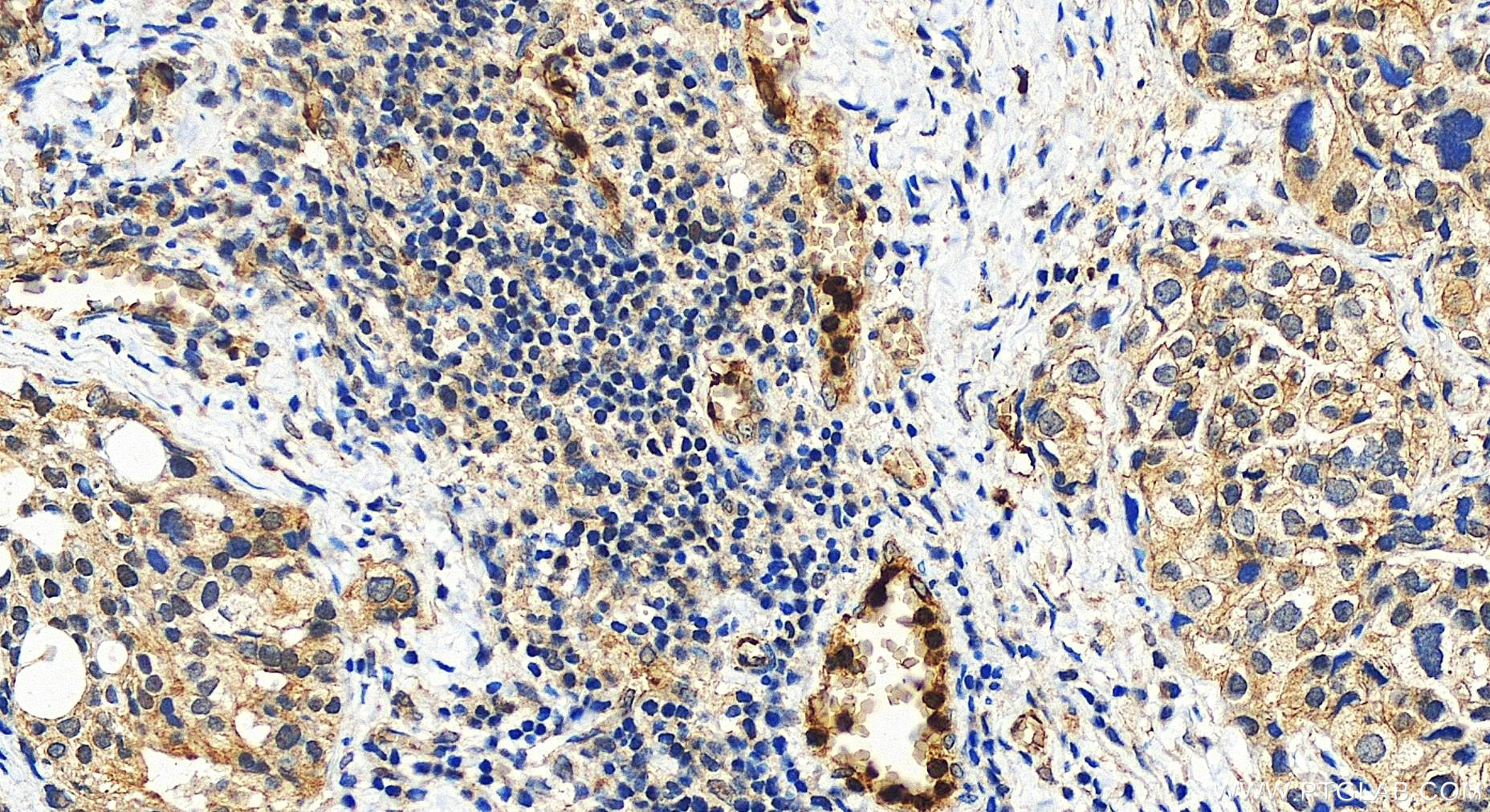 IHC staining of human ovary cancer using 55270-1-AP