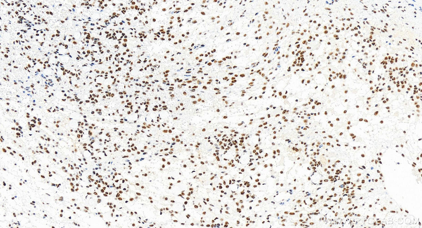 IHC staining of human ovary cancer using 82912-1-RR