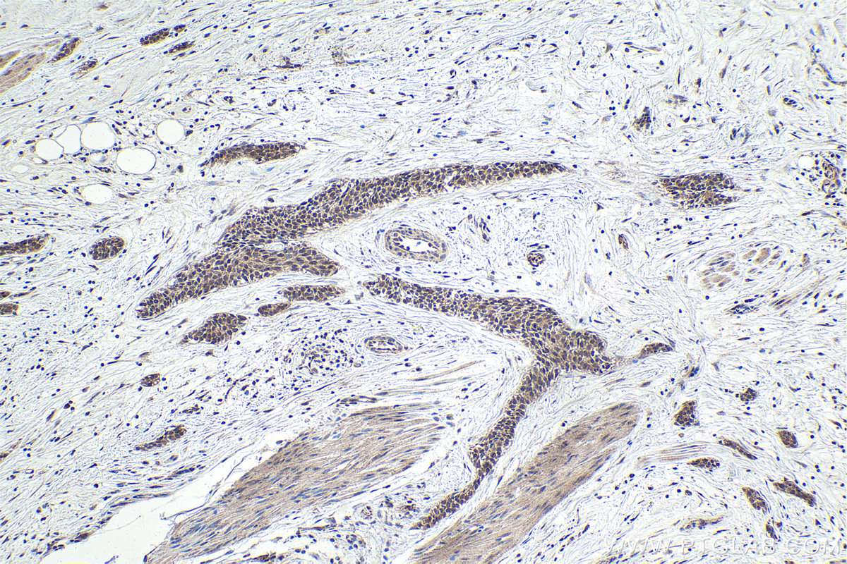 IHC staining of human urothelial carcinoma using 25009-1-AP