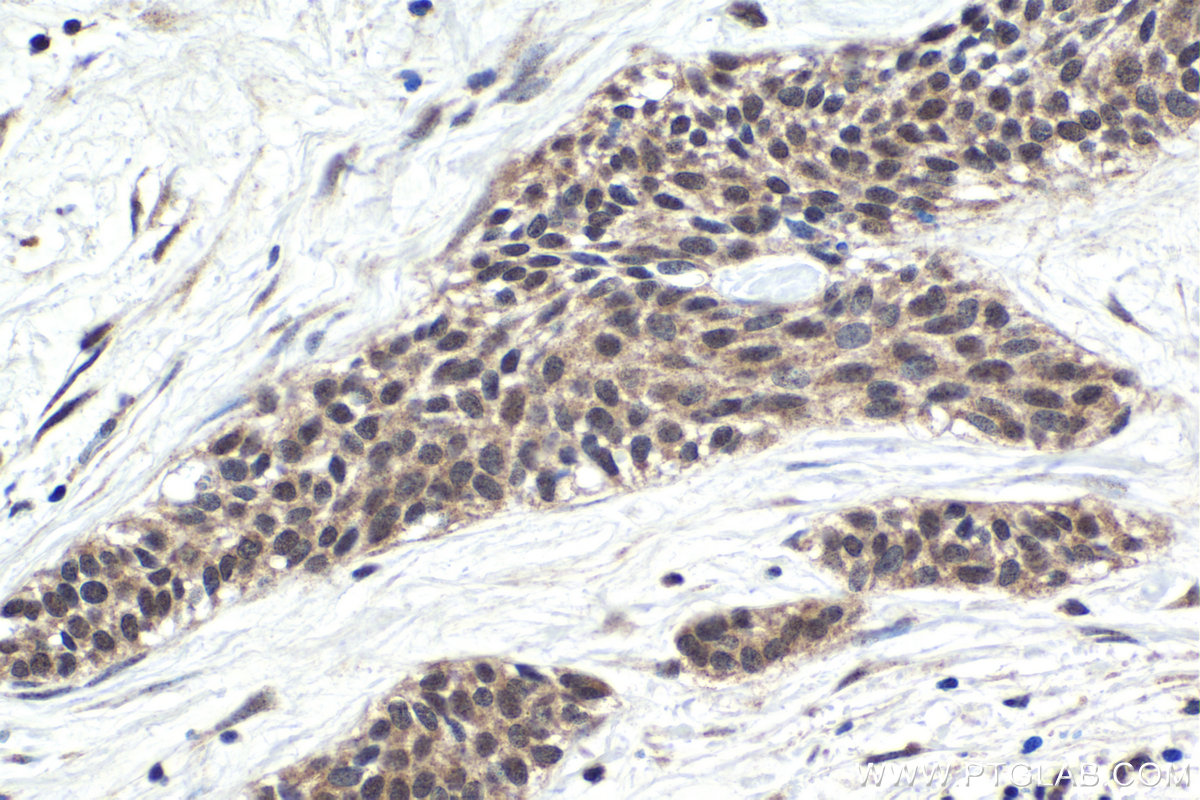 IHC staining of human urothelial carcinoma using 25009-1-AP