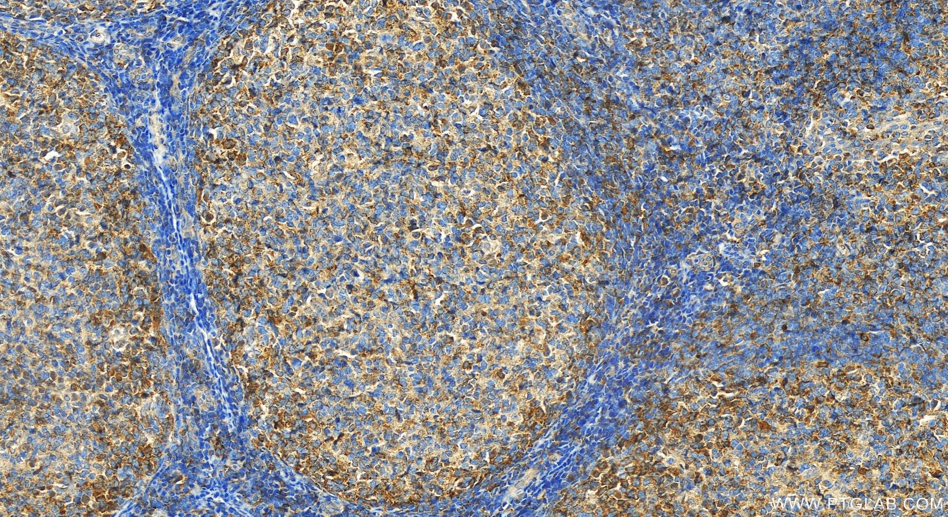 IHC staining of human tonsillitis using 24991-1-AP