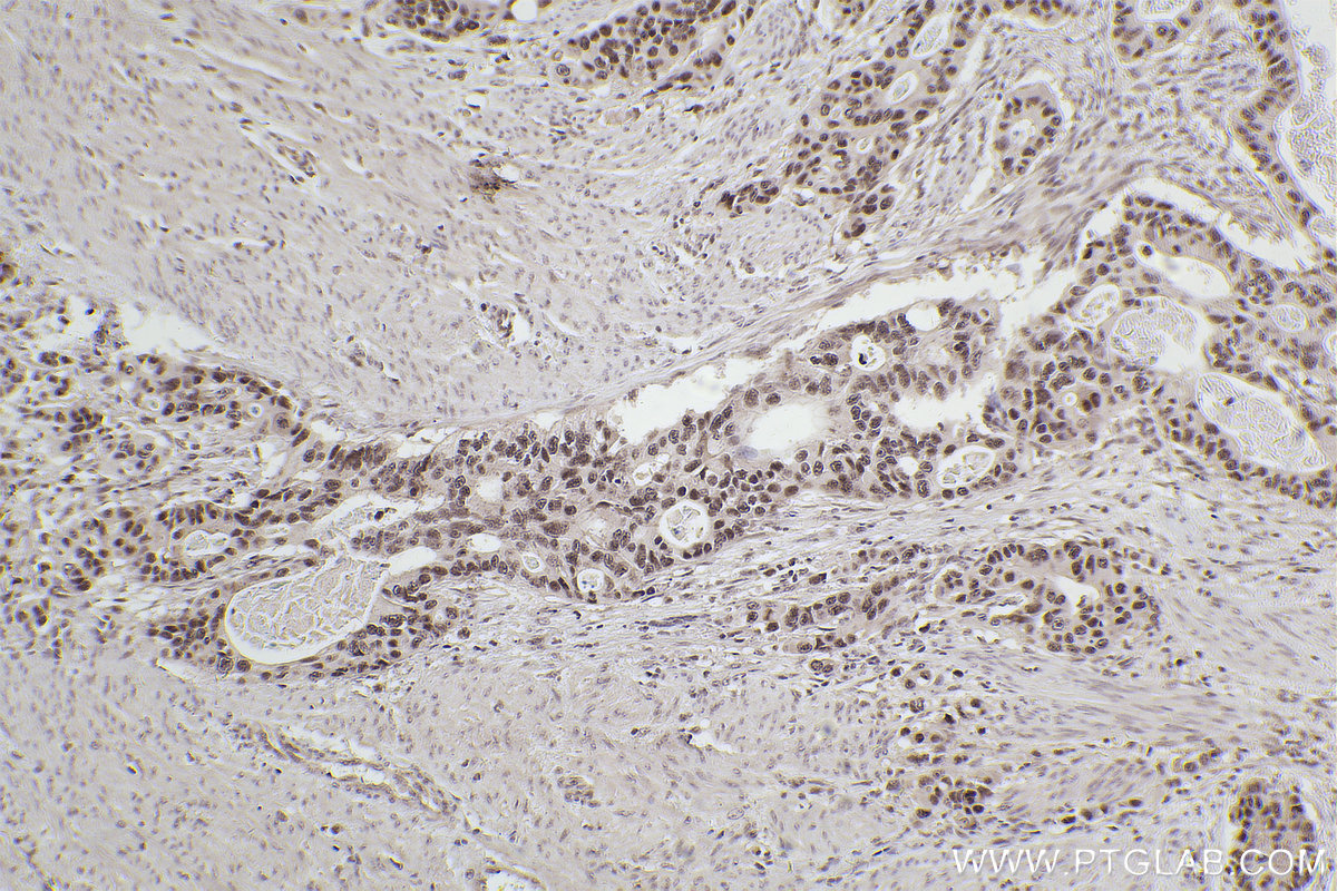 IHC staining of human stomach cancer using 68526-1-Ig (same clone as 68526-1-PBS)