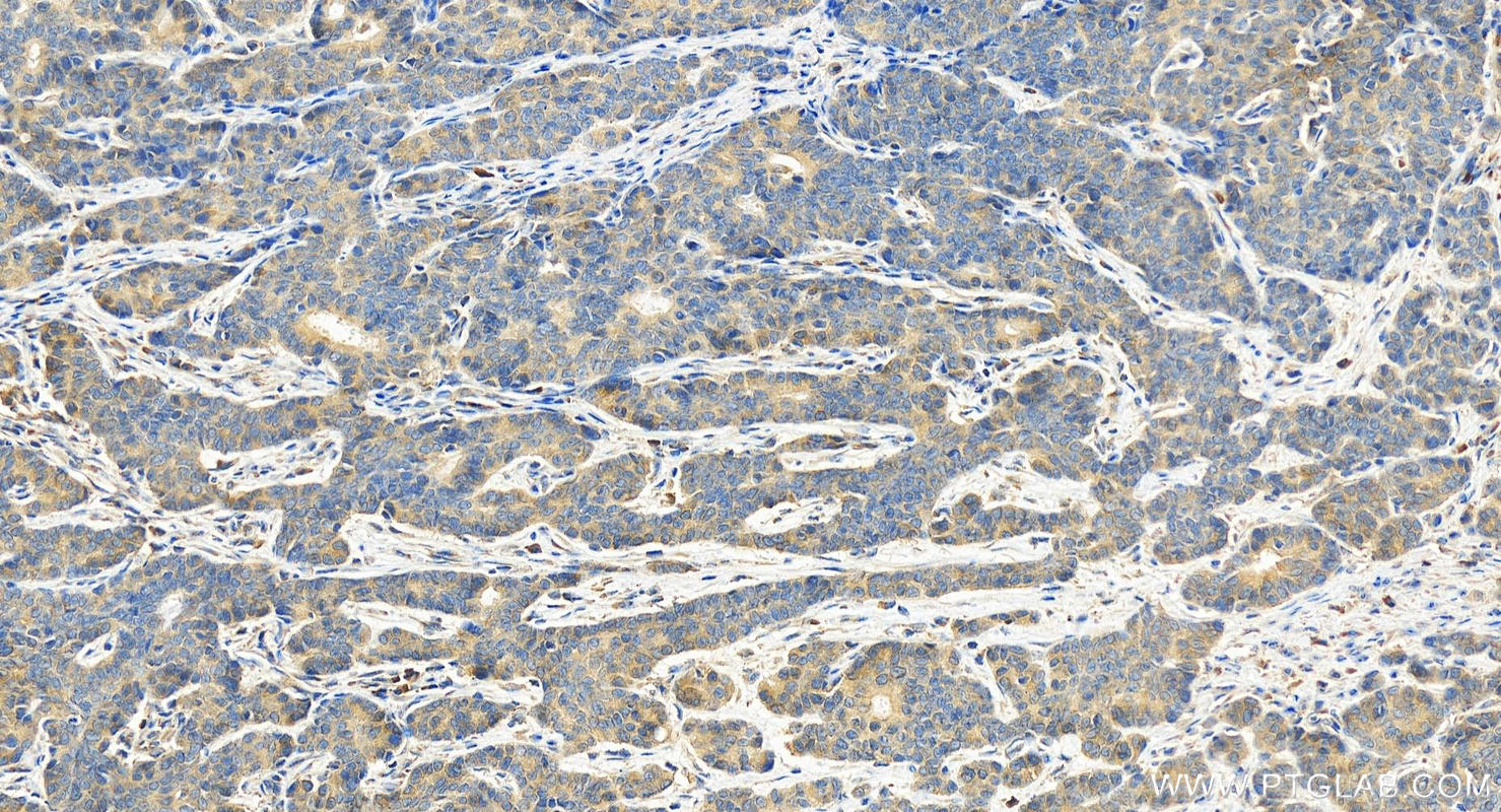 IHC staining of human stomach cancer using 16820-1-AP