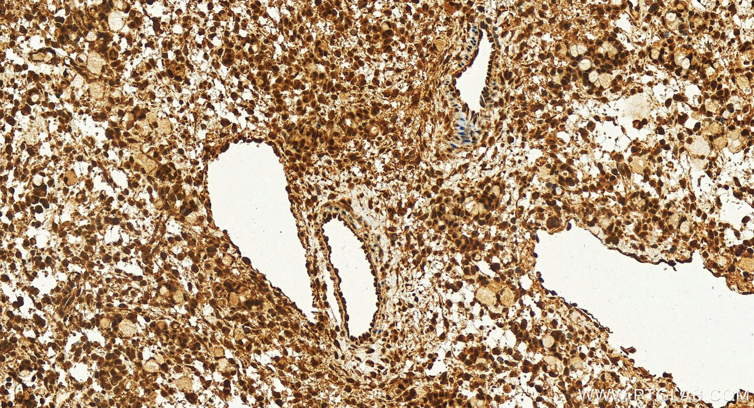 IHC staining of human ovary cancer using 25629-1-AP