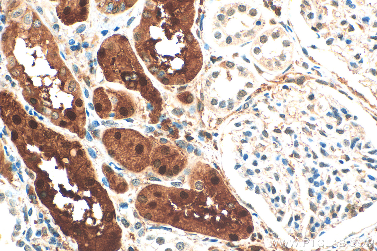 IHC staining of human renal cell carcinoma using 82020-1-RR (same clone as 82020-1-PBS)