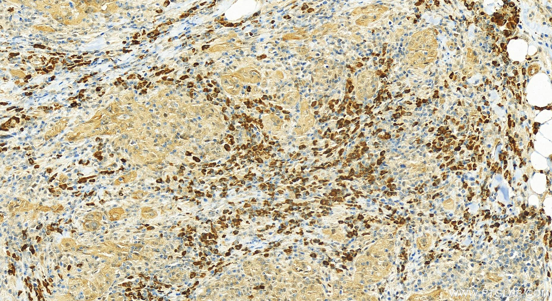 IHC staining of human skin cancer using 19005-1-AP