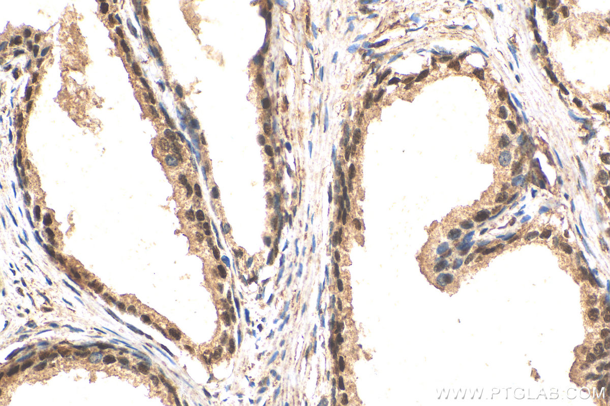 IHC staining of human prostate cancer using 28012-1-AP