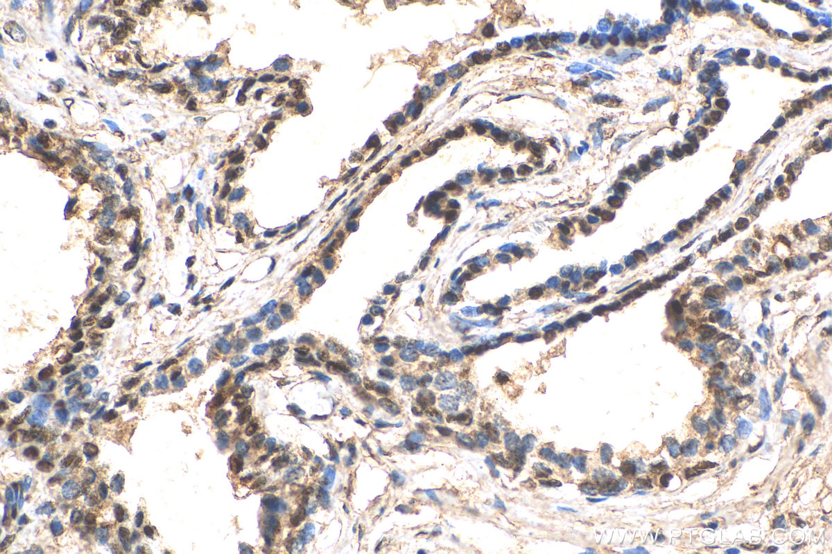 IHC staining of human prostate cancer using 28012-1-AP