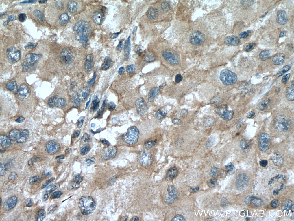 IHC staining of human liver cancer using 23163-1-AP