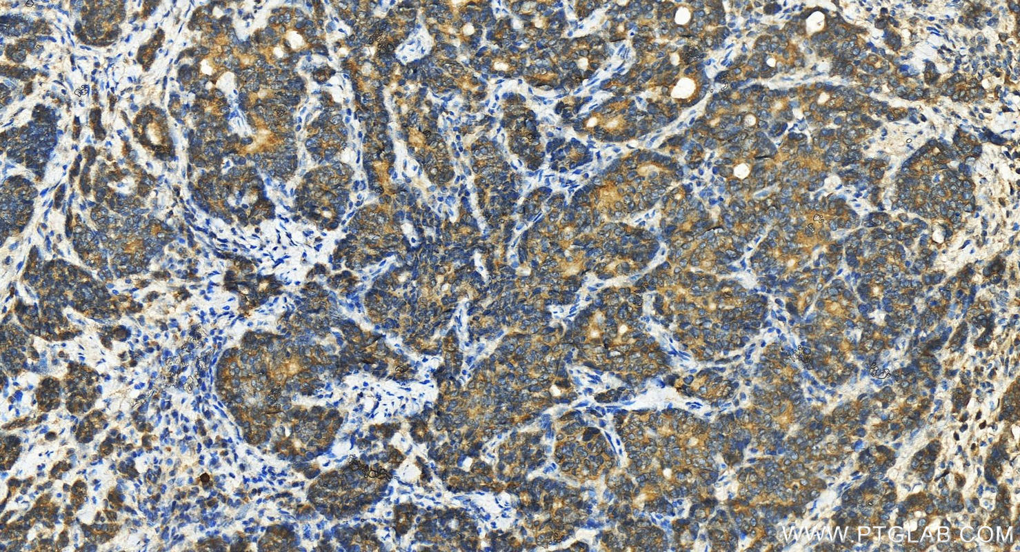 IHC staining of human stomach cancer using 12680-1-AP