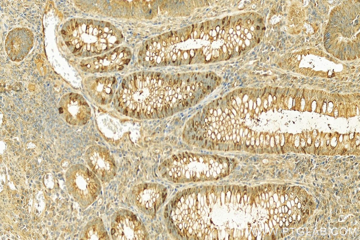 IHC staining of human colon cancer using 17397-1-AP (same clone as 17397-1-PBS)