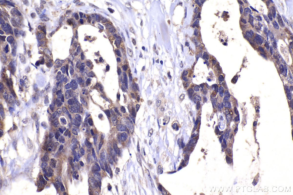 IHC staining of human urothelial carcinoma using 21717-1-AP