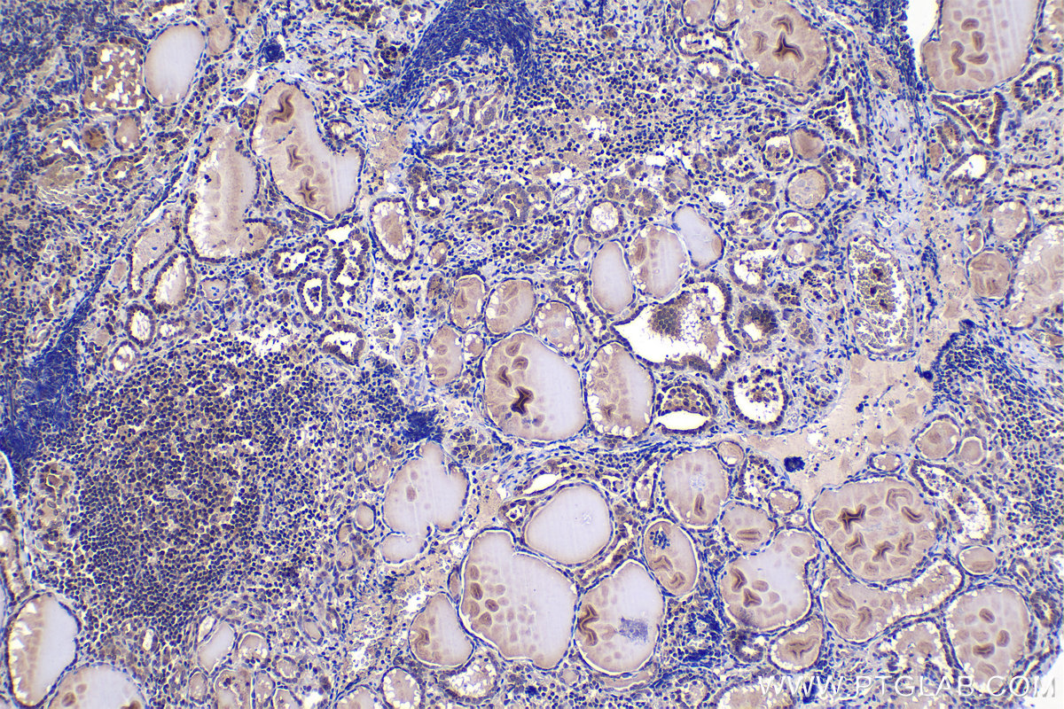 IHC staining of human thyroid cancer using 21717-1-AP