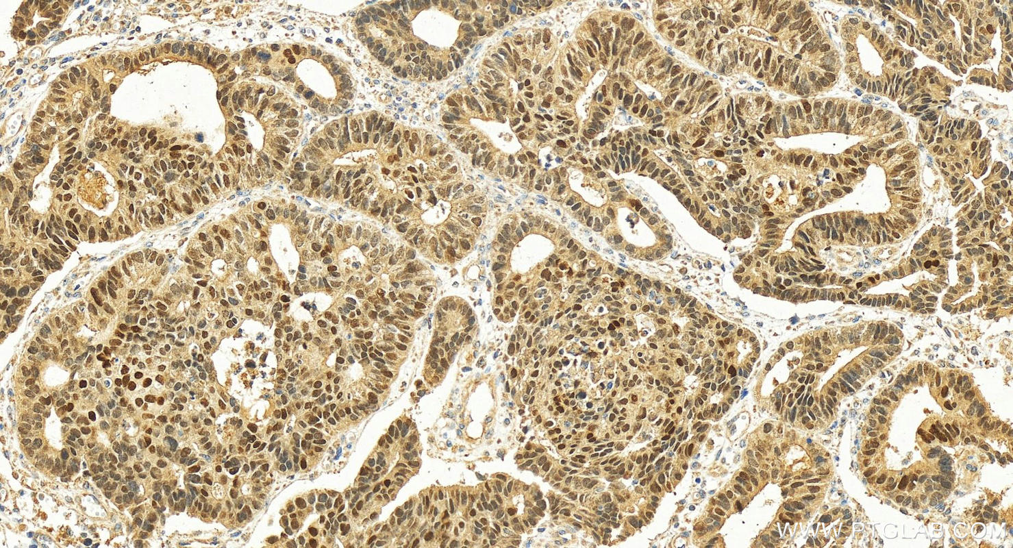 IHC staining of human stomach cancer using 25599-1-AP