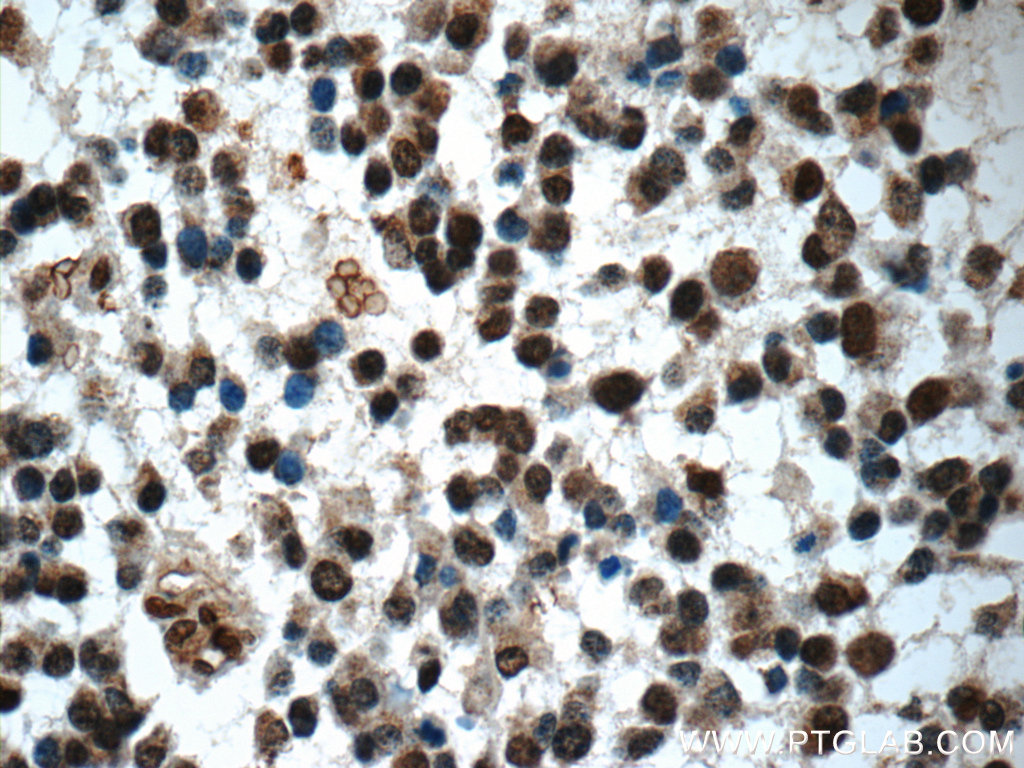 IHC staining of human gliomas using 25216-1-AP