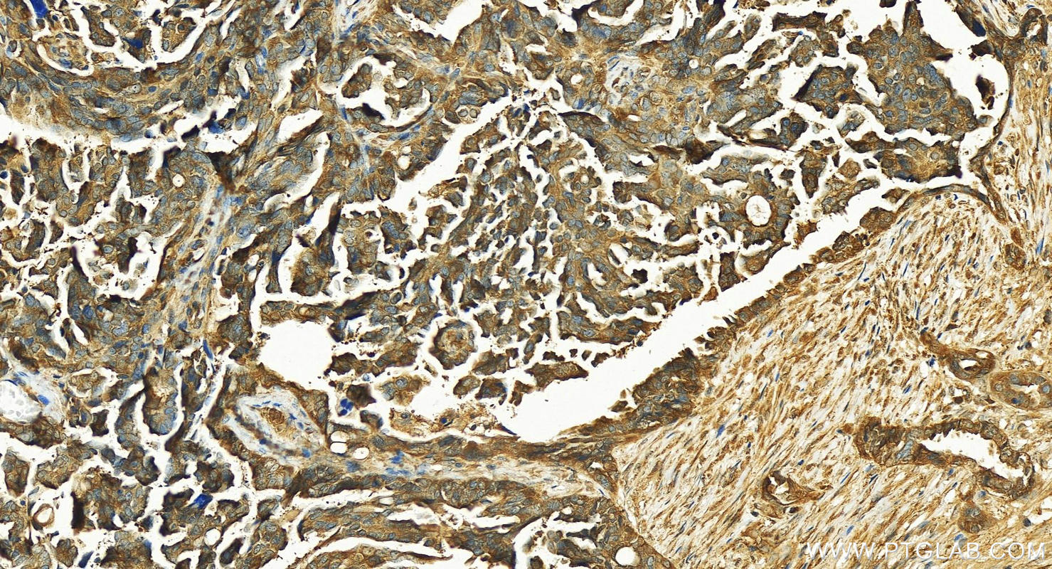 IHC staining of human ovary cancer using 15558-1-AP