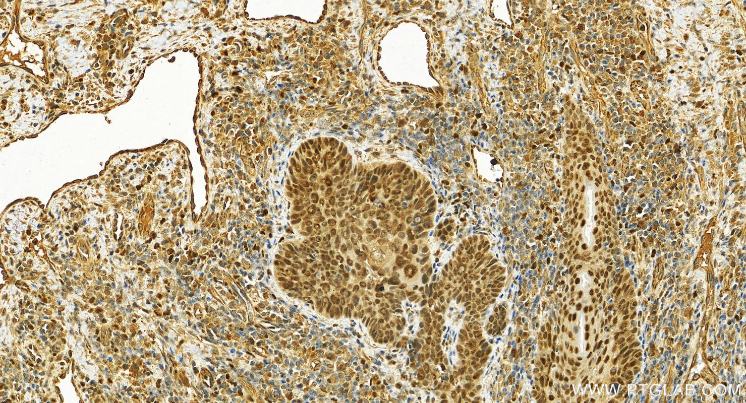 IHC staining of human brown disease using 26288-1-AP