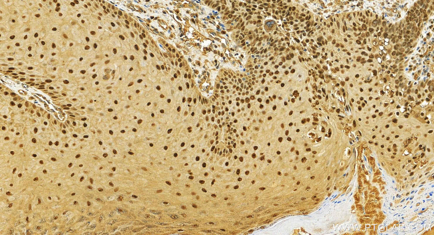 IHC staining of human brown disease using 26288-1-AP