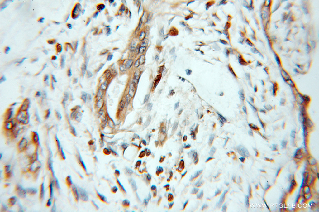 IHC staining of human pancreas cancer using 11759-1-AP