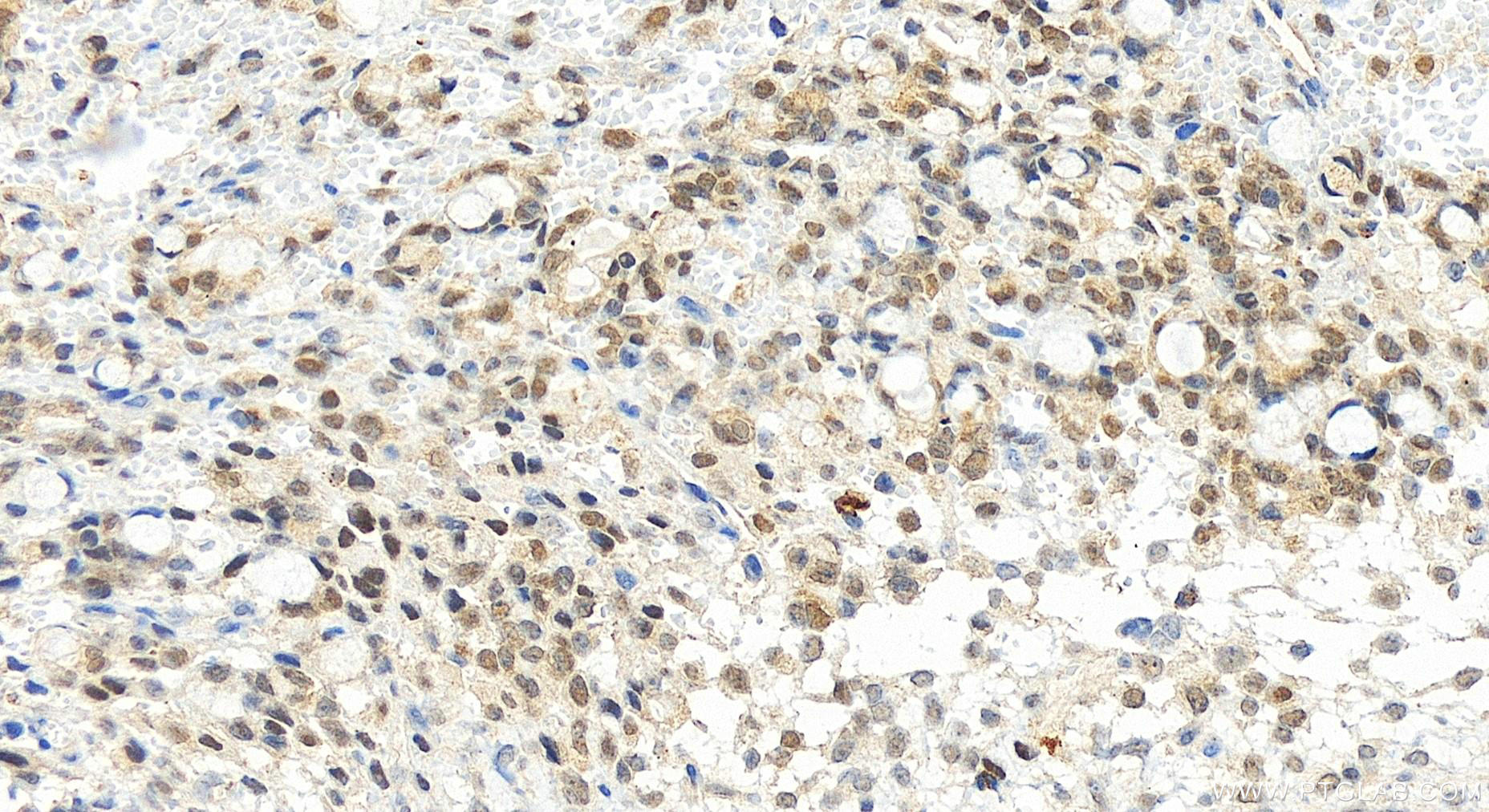 IHC staining of human ovary cancer using 20934-1-AP