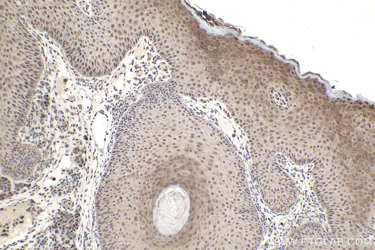 IHC staining of human malignant melanoma using 21075-1-AP