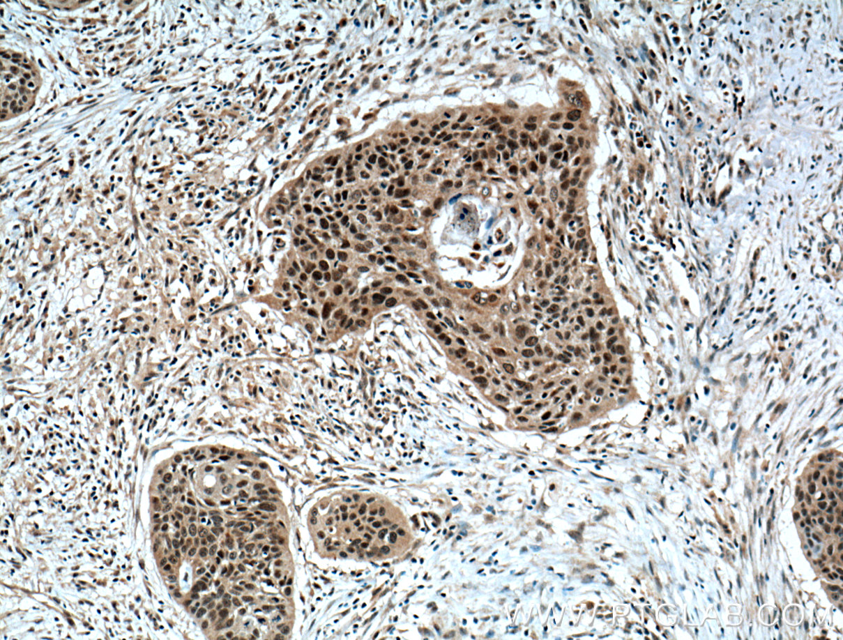 IHC staining of human oesophagus cancer using 21752-1-AP