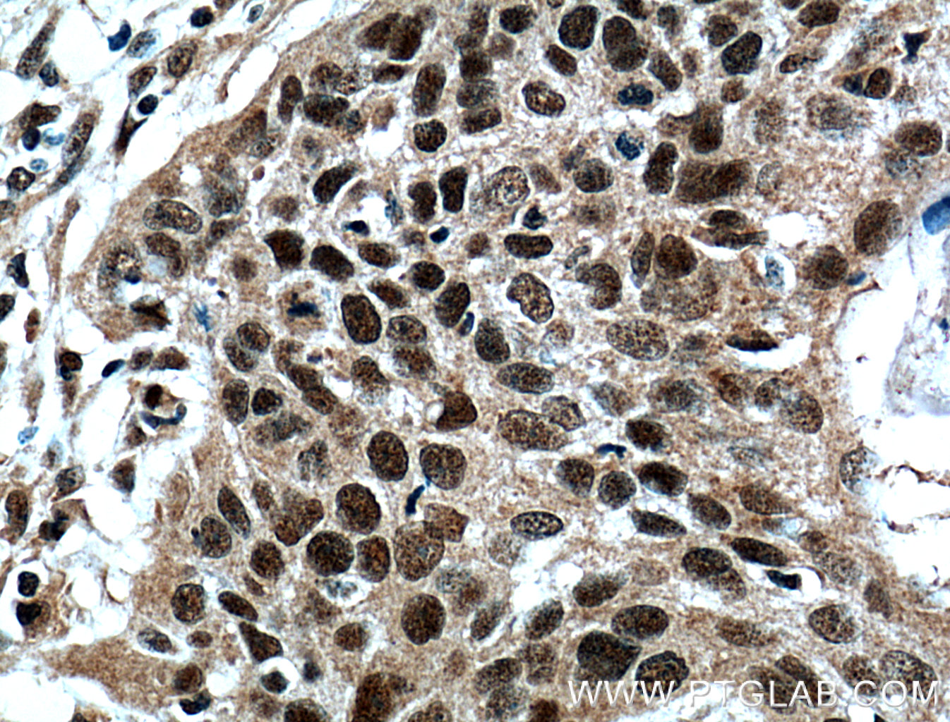 IHC staining of human oesophagus cancer using 21752-1-AP