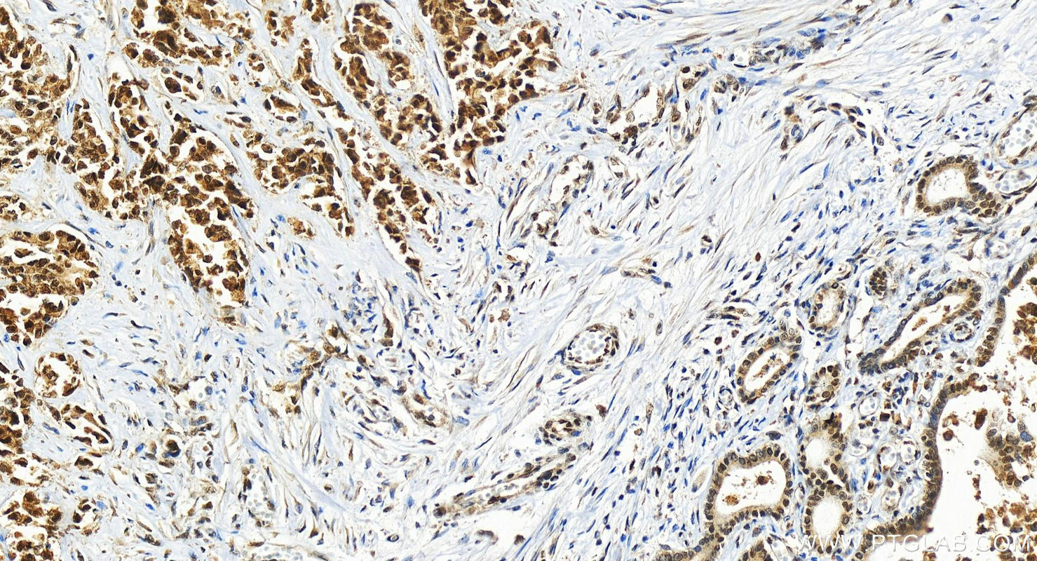 IHC staining of human intrahepatic cholangiocarcinoma using 26315-1-AP