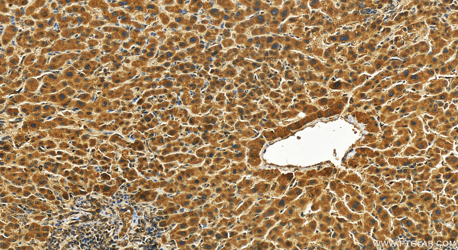 IHC staining of human intrahepatic cholangiocarcinoma using 25604-1-AP