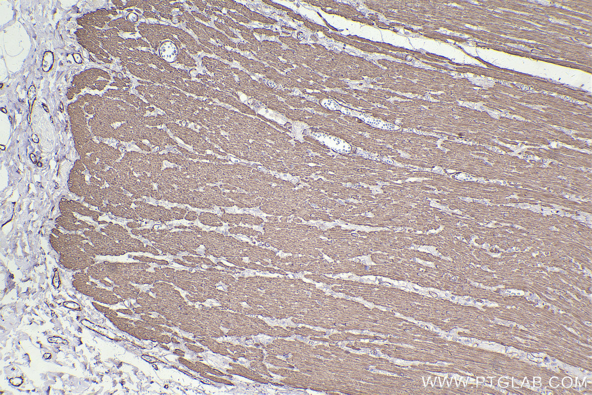 IHC staining of human rectal cancer using 80008-1-RR