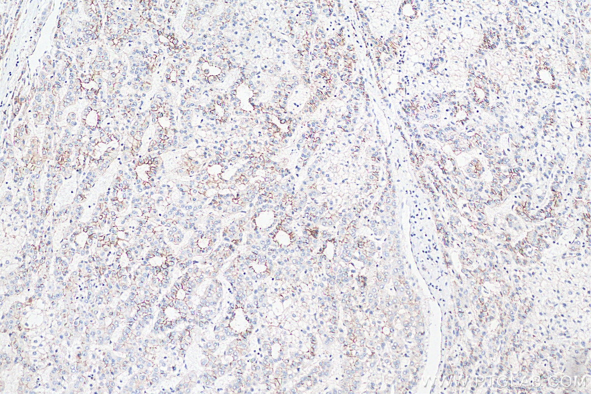 IHC staining of human liver cancer using 51067-2-AP