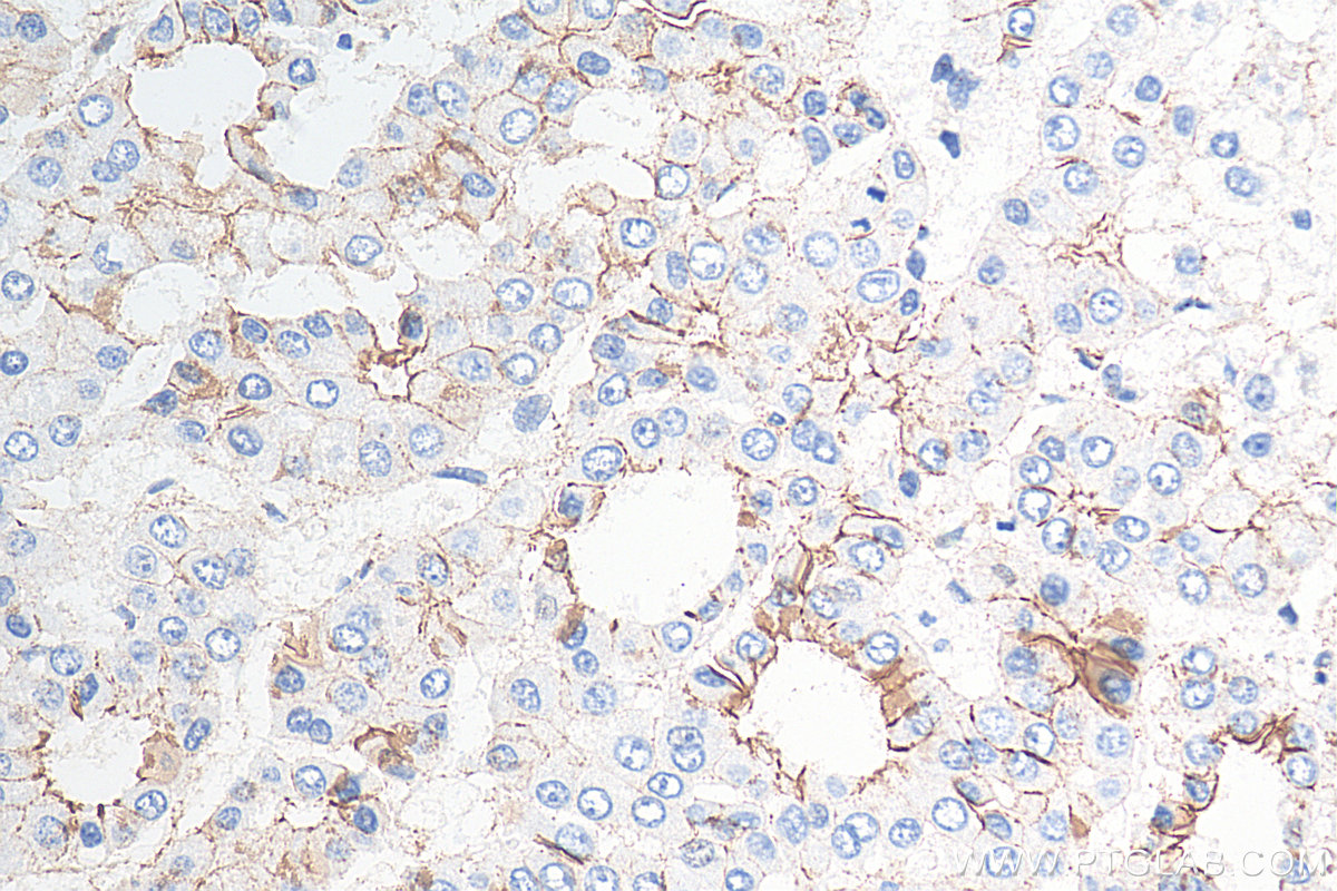 IHC staining of human liver cancer using 51067-2-AP